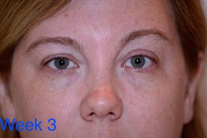 Clarisonic Opal Trial - week 3